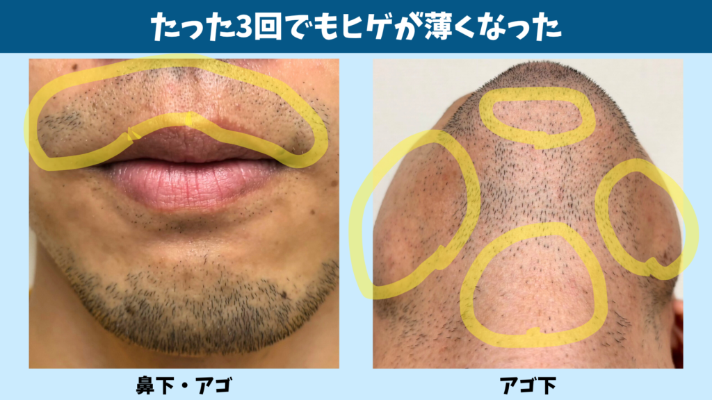 ヒゲ脱毛を3回受けてヒゲが薄くなった様子を示した比較画像