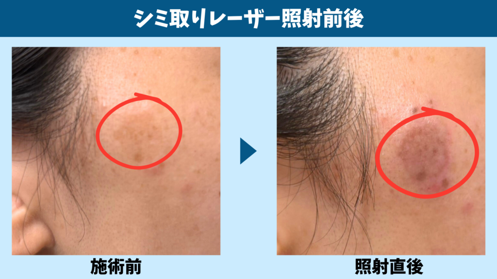 シミ取りレーザーの照射前と照射直後のシミを比較した図解