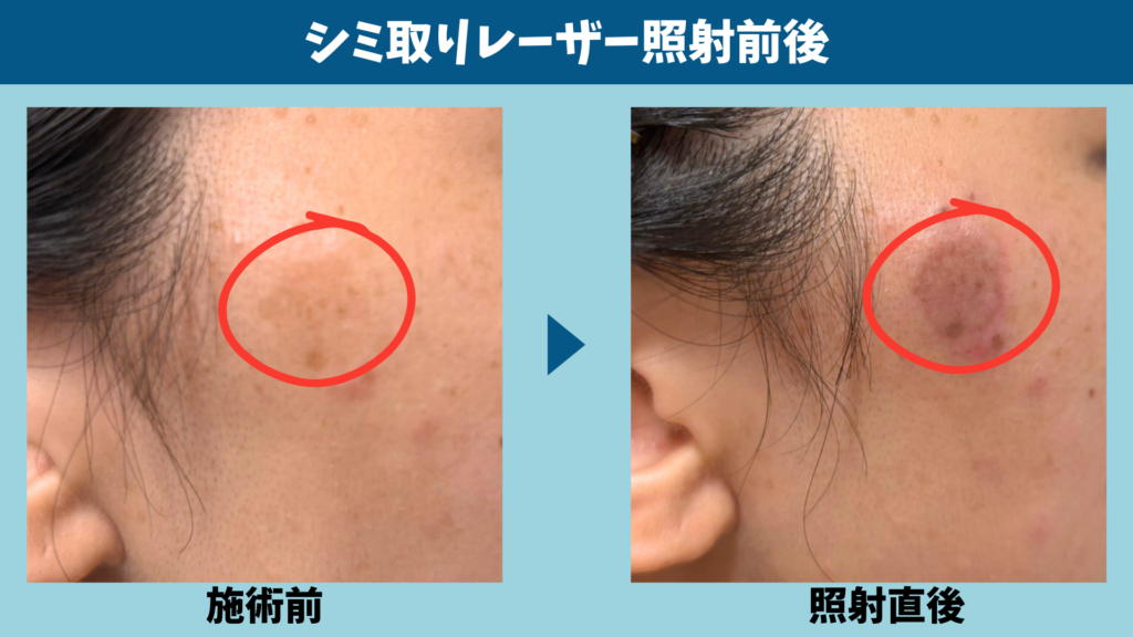 シミ取りレーザーの施術前と照射直後の頬を並べ、照射したシミを赤丸で示した写真