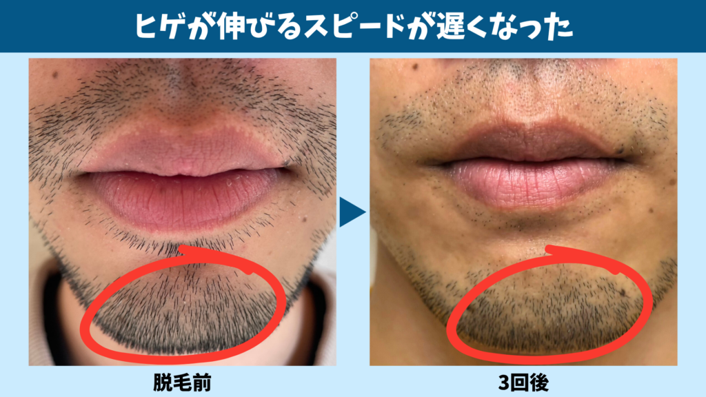 ヒゲ脱毛を3回受けてヒゲが伸びる速度が落ちたことを示した画像