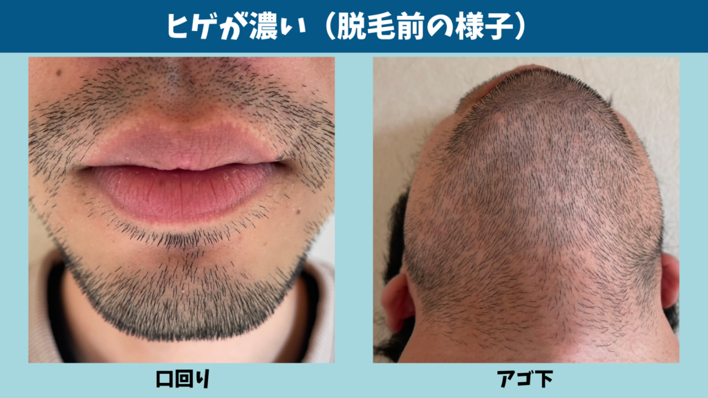 毛が濃く根が深いヒゲの状態を示した図解