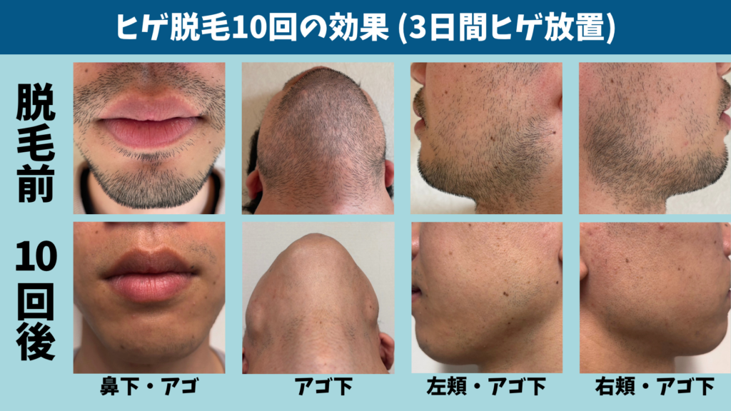 ヒゲ脱毛1回目と10回目のヒゲの様子を部位ごとに並べた比較図