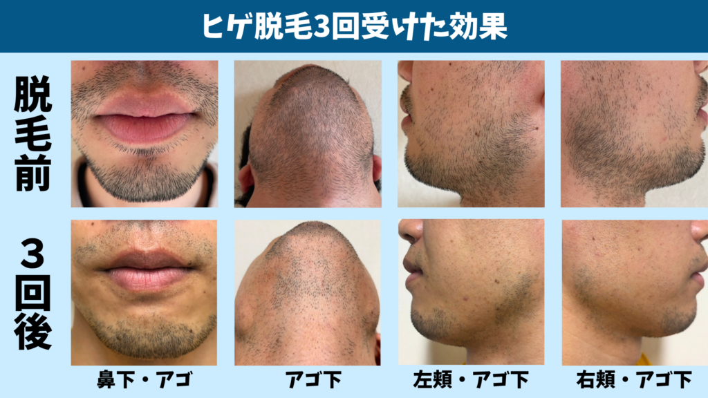 湘南美容クリニックでヒゲ脱毛を3回受けた効果を示した比較画像