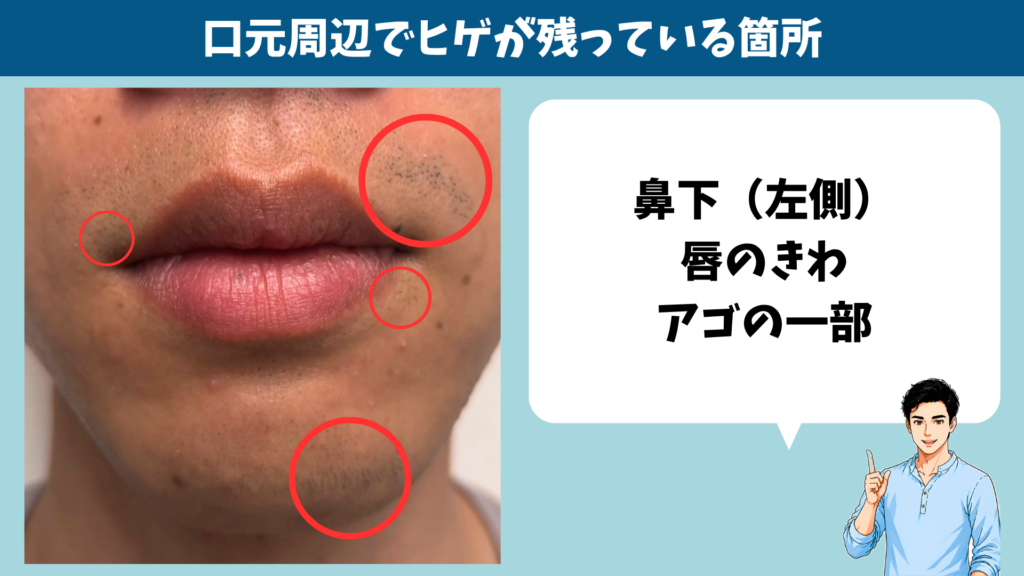 口元周辺でヒゲが残っている箇所
