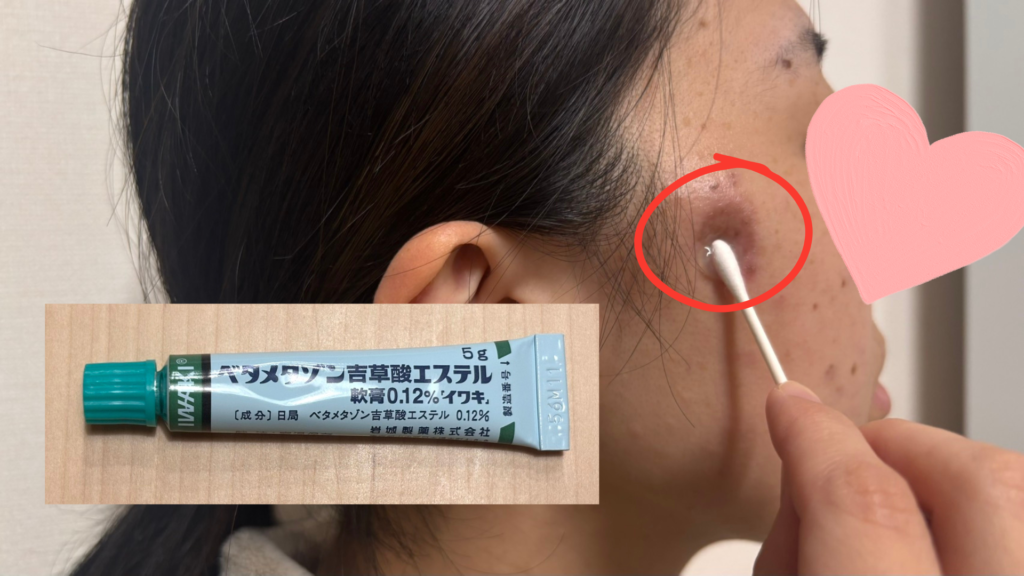 施術後に処方されたベタメタゾン吉草酸エステル軟膏を、綿棒で照射した部分に塗っている様子