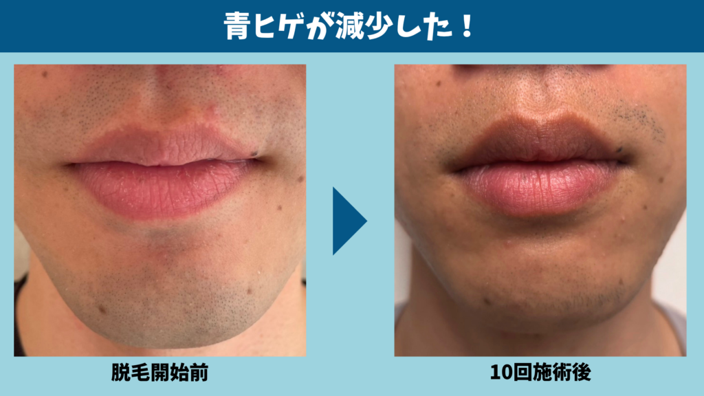 ヒゲ脱毛で青ヒゲが減少したことを示した図解