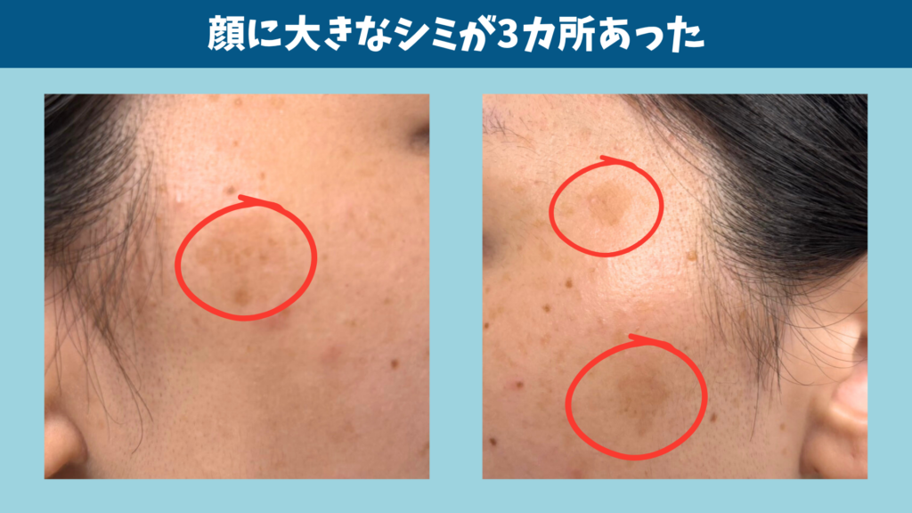 レーゼ治療を受ける前の顔のシミ3カ所のアップ画像