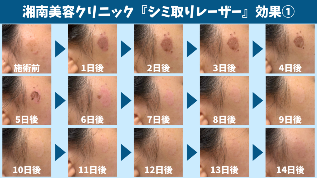 シミ取りレーザー施術前のシミの状態を写した画像