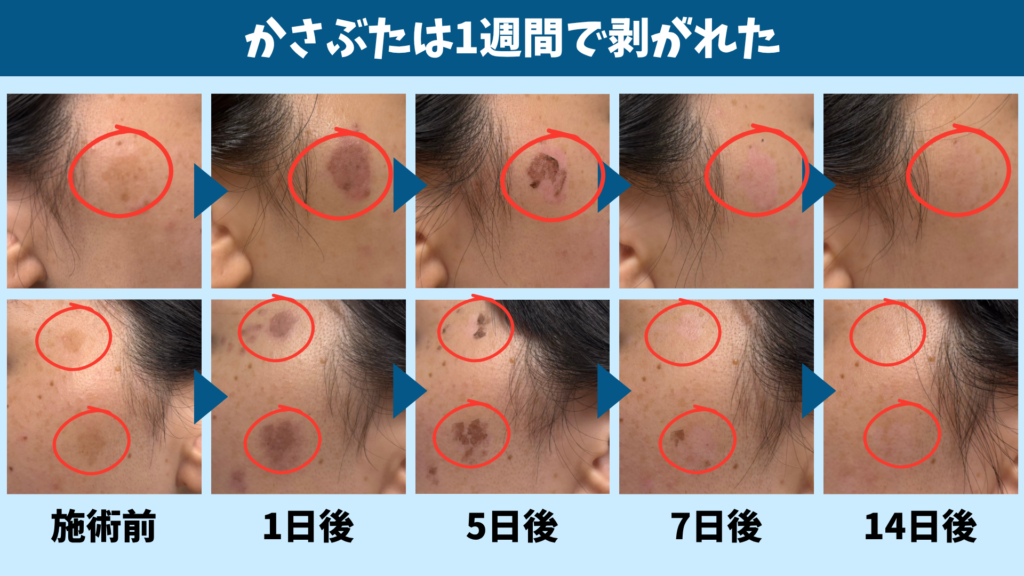 シミ取りレーザー後のかさぶたが1週間で剥がれるまでの流れを示した画像