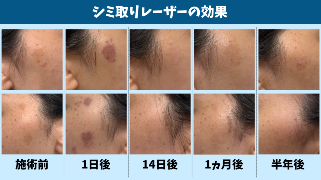 シミ取りレーザーの施術前と施術後のシミの変化を比較した画像