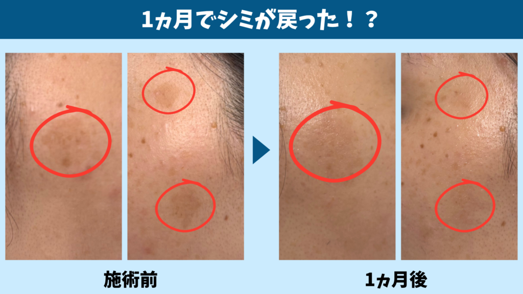 シミ取りレーザーの施術前と1か月後のシミを比較した画像
