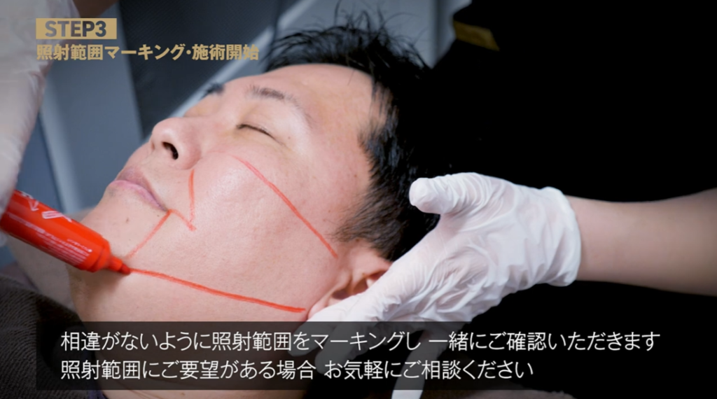 ゴリラクリニックで照射範囲をマーキングする様子