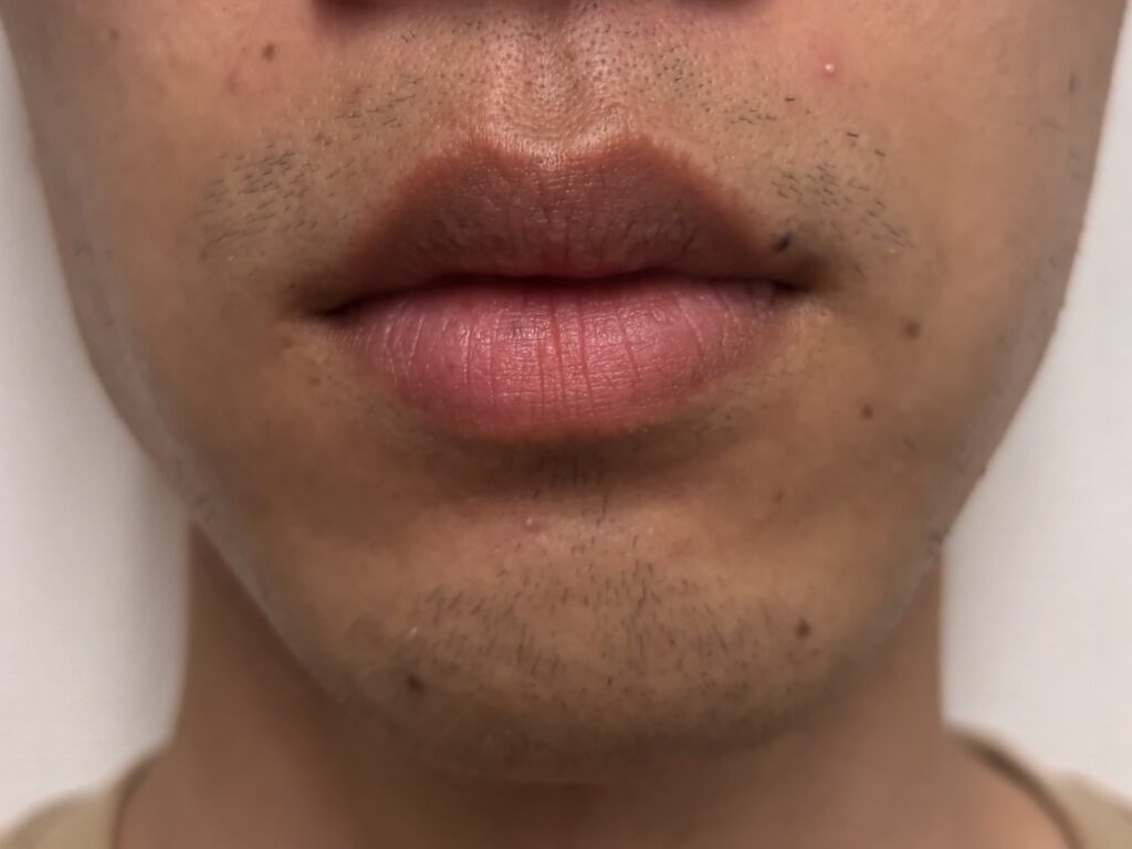 鼻下とあごにヒゲが生えそろってきた状態の写真
