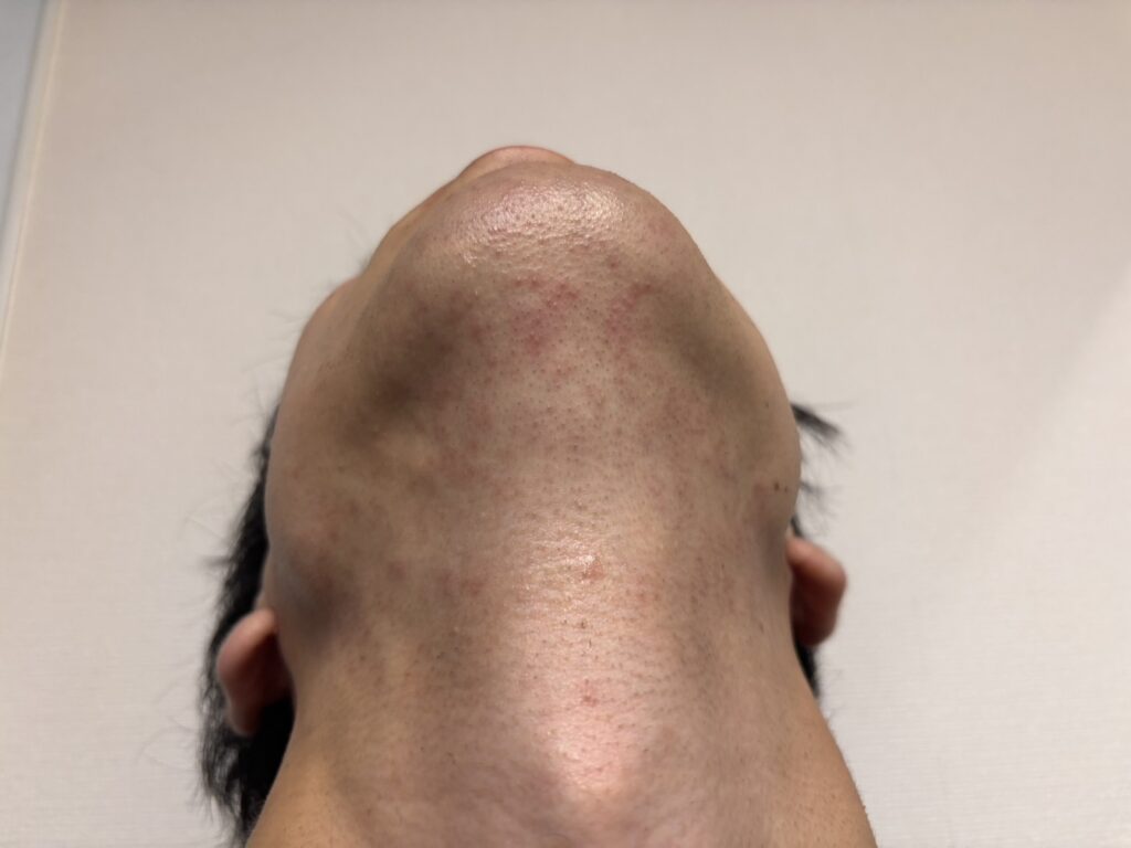 メンズリゼで麻酔なしのヒゲ脱毛を受けた直後のあご下の様子