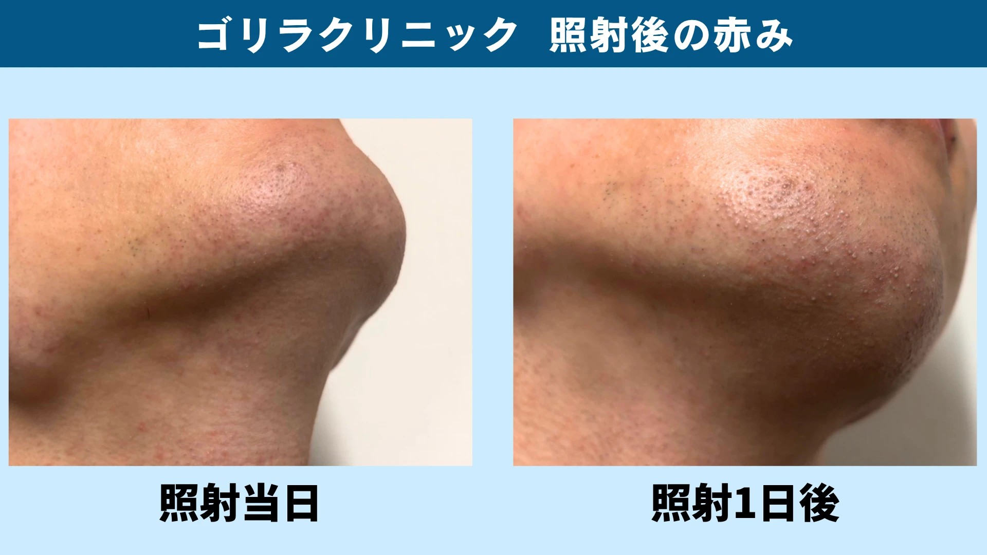 ゴリラクリニックのヒゲ脱毛の照射当日と照射1日後のアゴ。照射後にアゴ先とアゴ裏に赤みと小さなポツポツが出た
