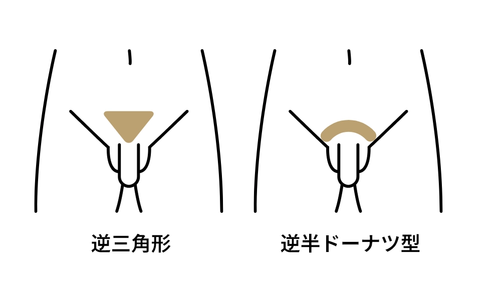 VIO脱毛でVラインを残すデザインの例。逆三角形と逆半ドーナツ型
