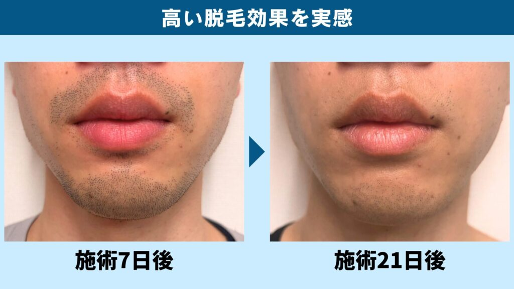 ゴリラクリニックのヤグレーザーで照射した7日後と21日後のヒゲの比較