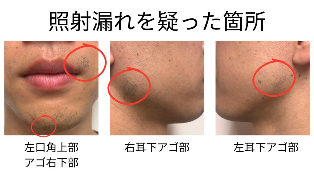 照射漏れを疑った4か所。左口角の上・アゴの右下・右耳の下のアゴ・左耳の下のアゴ