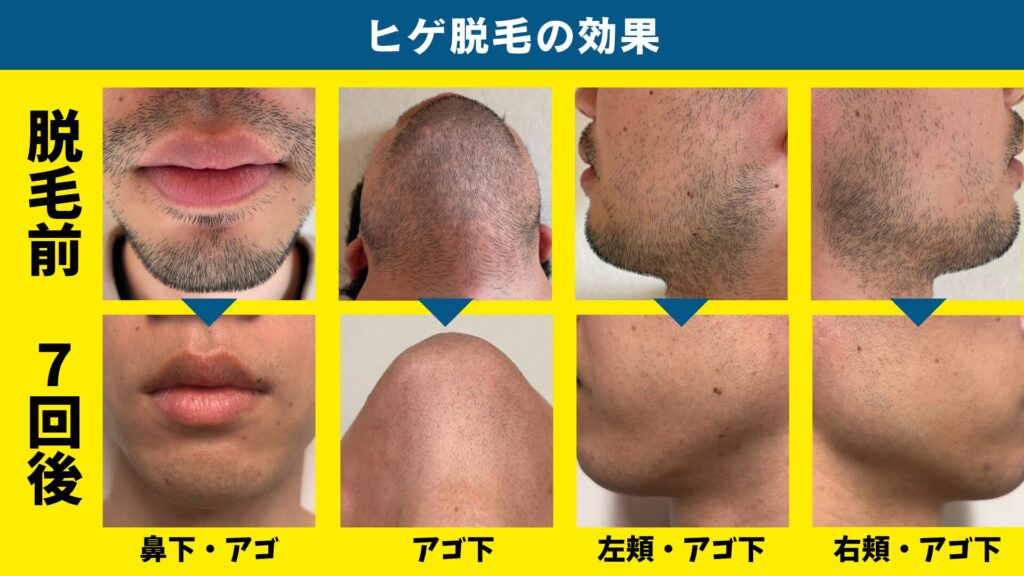 ヒゲ脱毛前と7回後の鼻下・アゴ・アゴ下・頬の様子を比べた写真