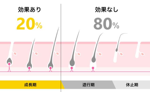 レーザーの効果があるのは成長期の毛（約20%）だけであることを示す毛周期の図