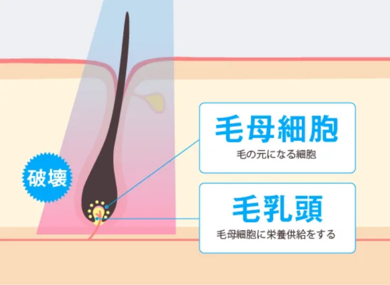 医療レーザーで毛母細胞と毛乳頭を破壊する仕組みを示したメンズリゼ公式の図
