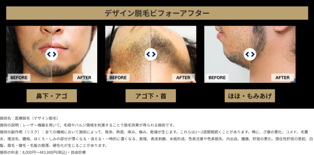 ゴリラクリニック公式サイトのデザイン脱毛のビフォーアフター(鼻下・アゴ/アゴ下・首/ほほ・もみあげ)