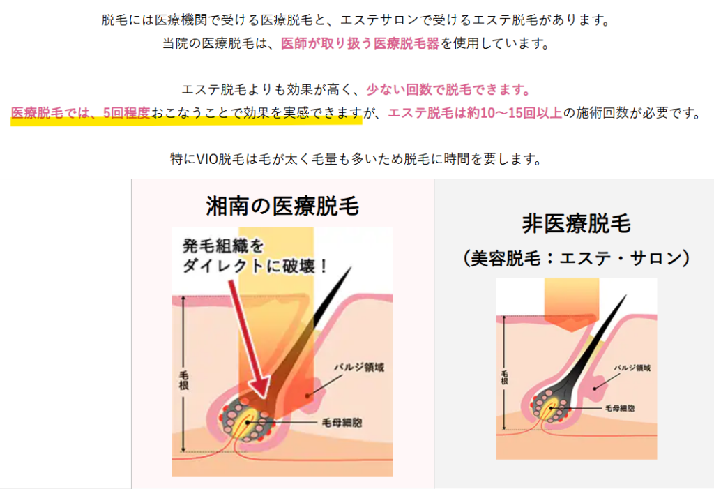 湘南美容クリニック公式の医療脱毛の説明（5回程度で効果を実感できる）