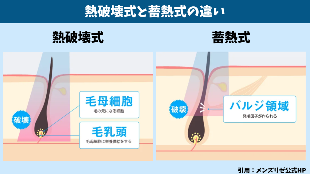 熱破壊式と蓄熱式の違い。熱破壊式は毛母細胞と毛乳頭を、蓄熱式はバルジ領域を破壊する