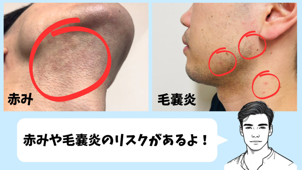 ヒゲ脱毛の照射後に出た赤みと毛嚢炎の写真