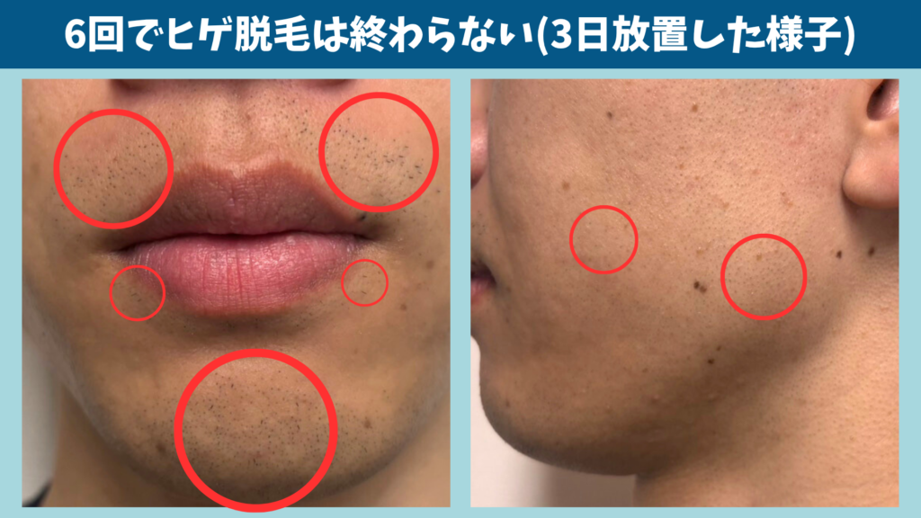 湘南美容クリニックのヒゲ脱毛6回後も口元と頬にヒゲが残っている様子（3日間ヒゲを放置）