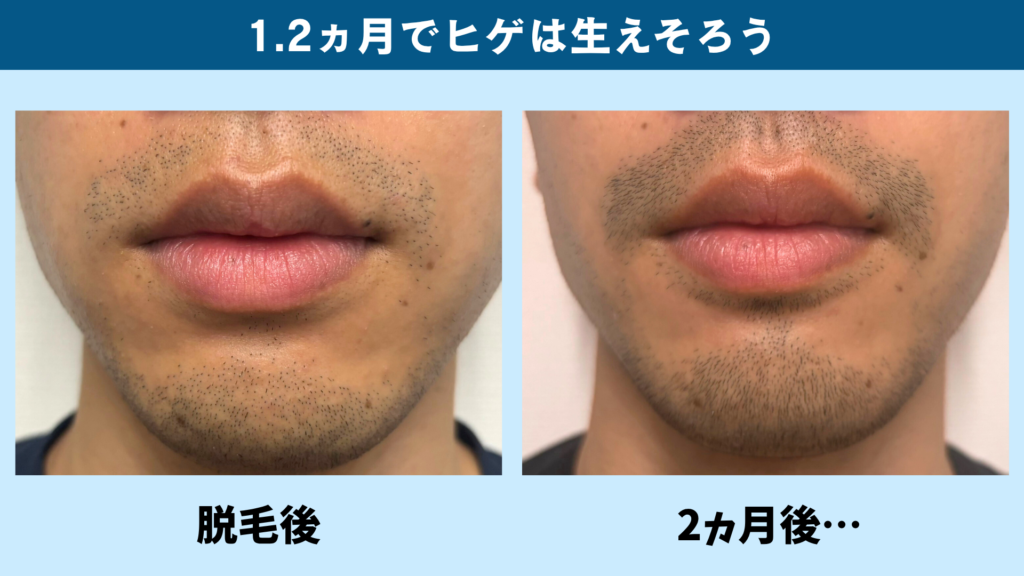 脱毛後と2か月後の口周りのヒゲ(約1.2か月で生えそろう)