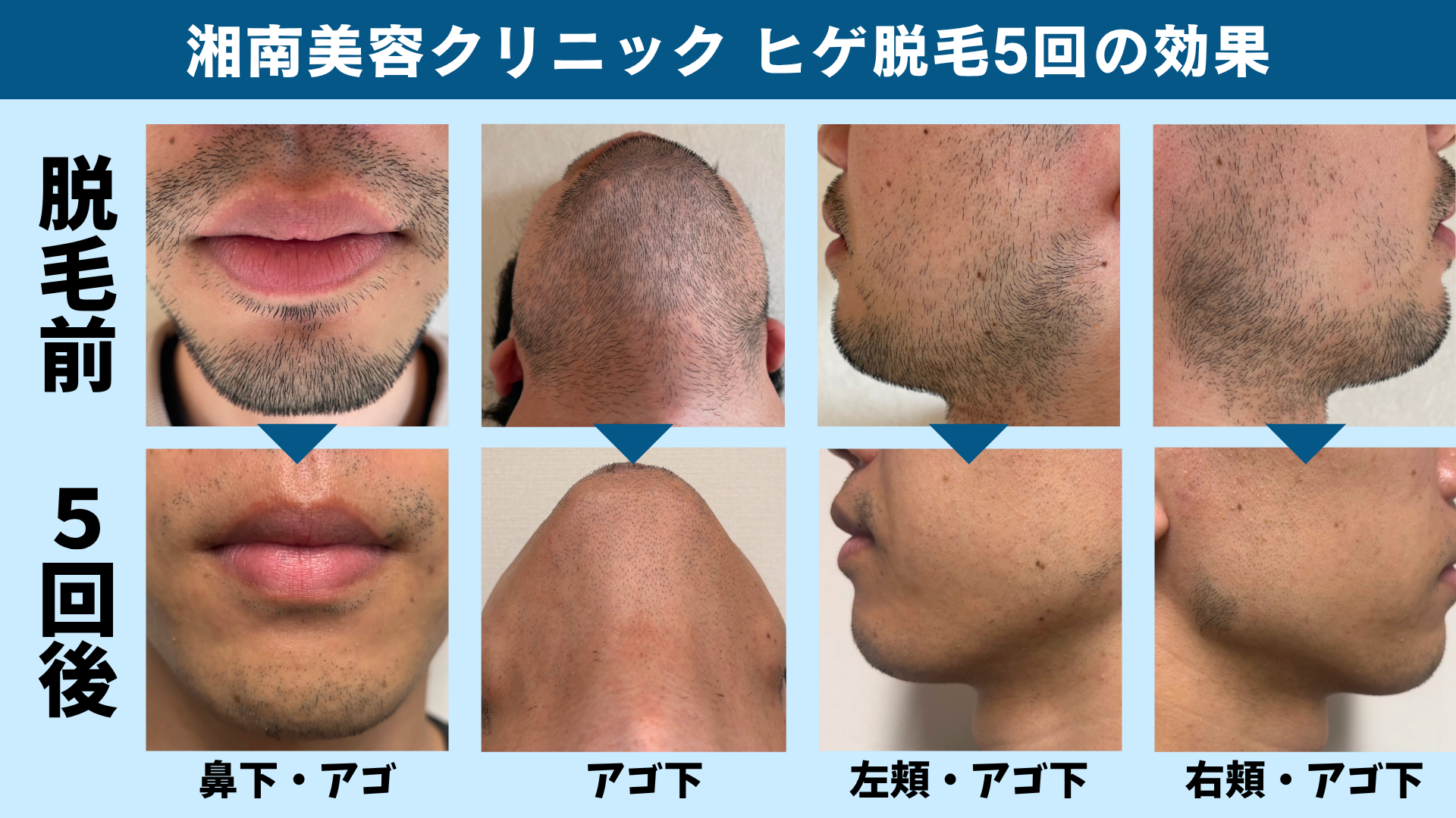 湘南美容クリニックのヒゲ脱毛前と5回後の比較（鼻下・アゴ・アゴ下・頬）